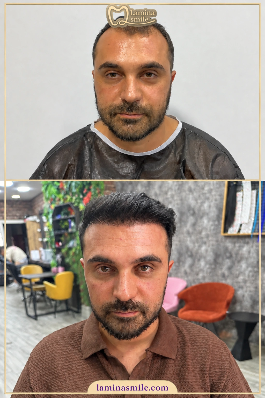 Clinic-supplied hair restoration case 6