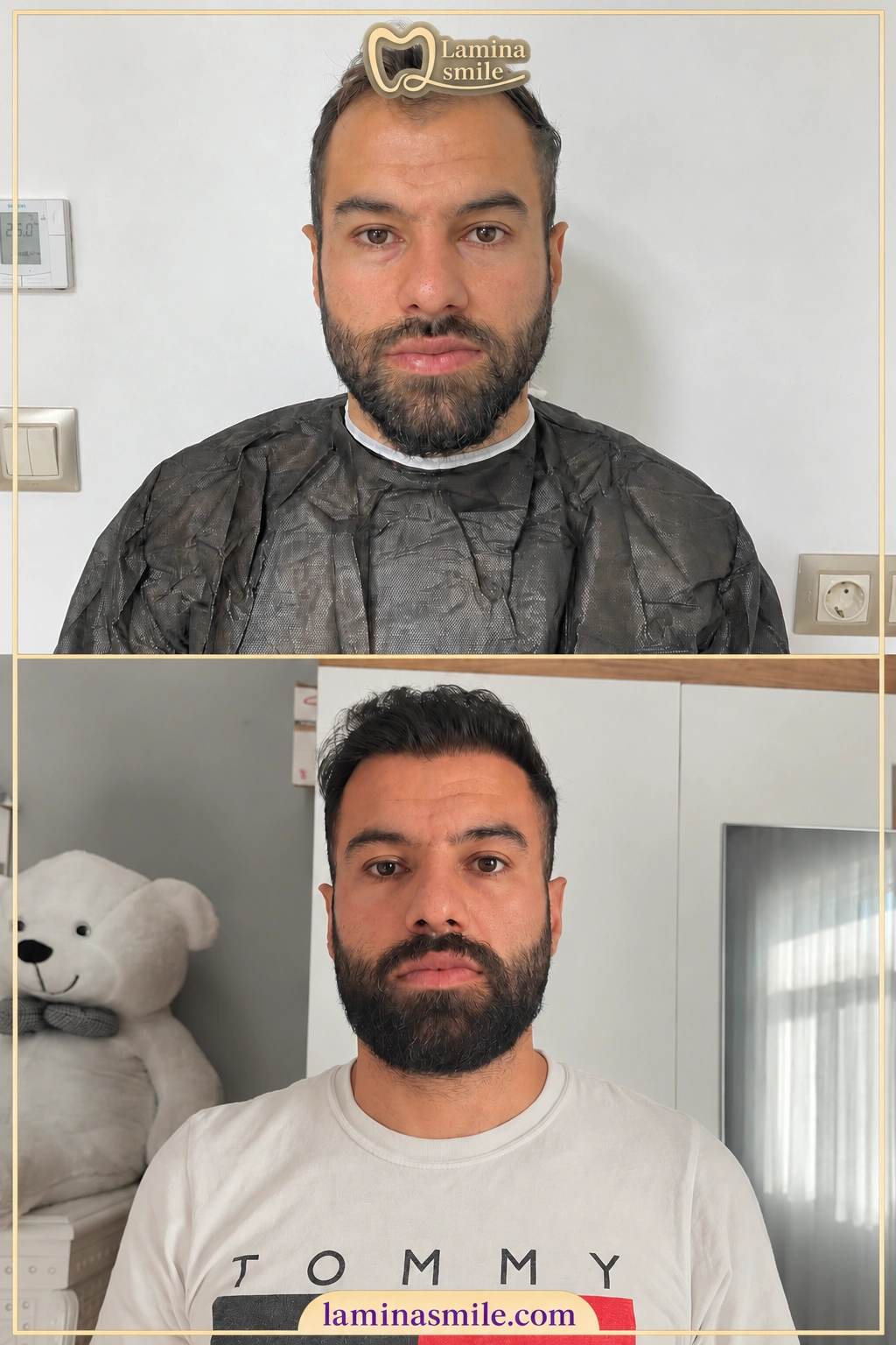 Clinic-supplied hair restoration case 5