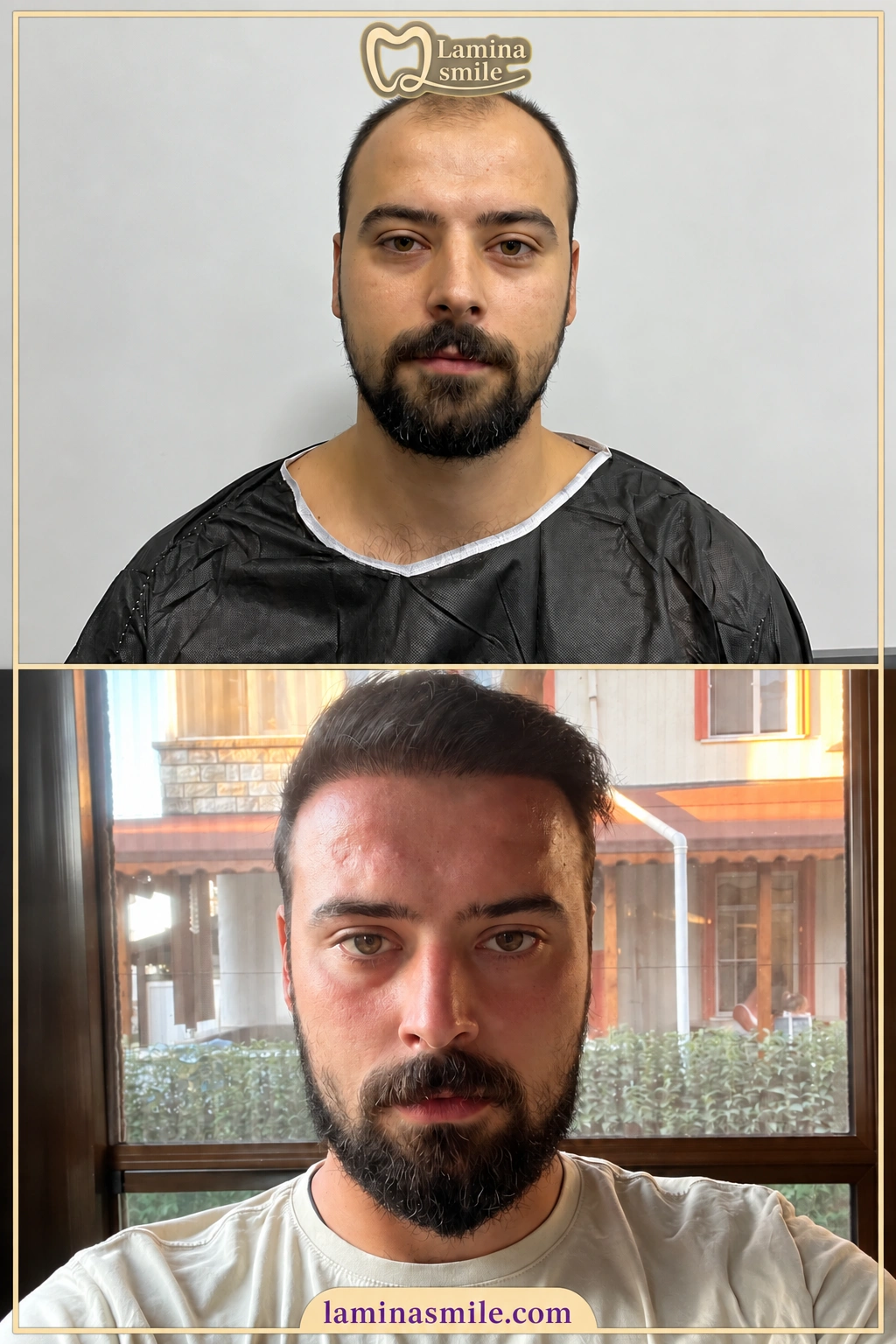 Clinic-supplied hair restoration case 4