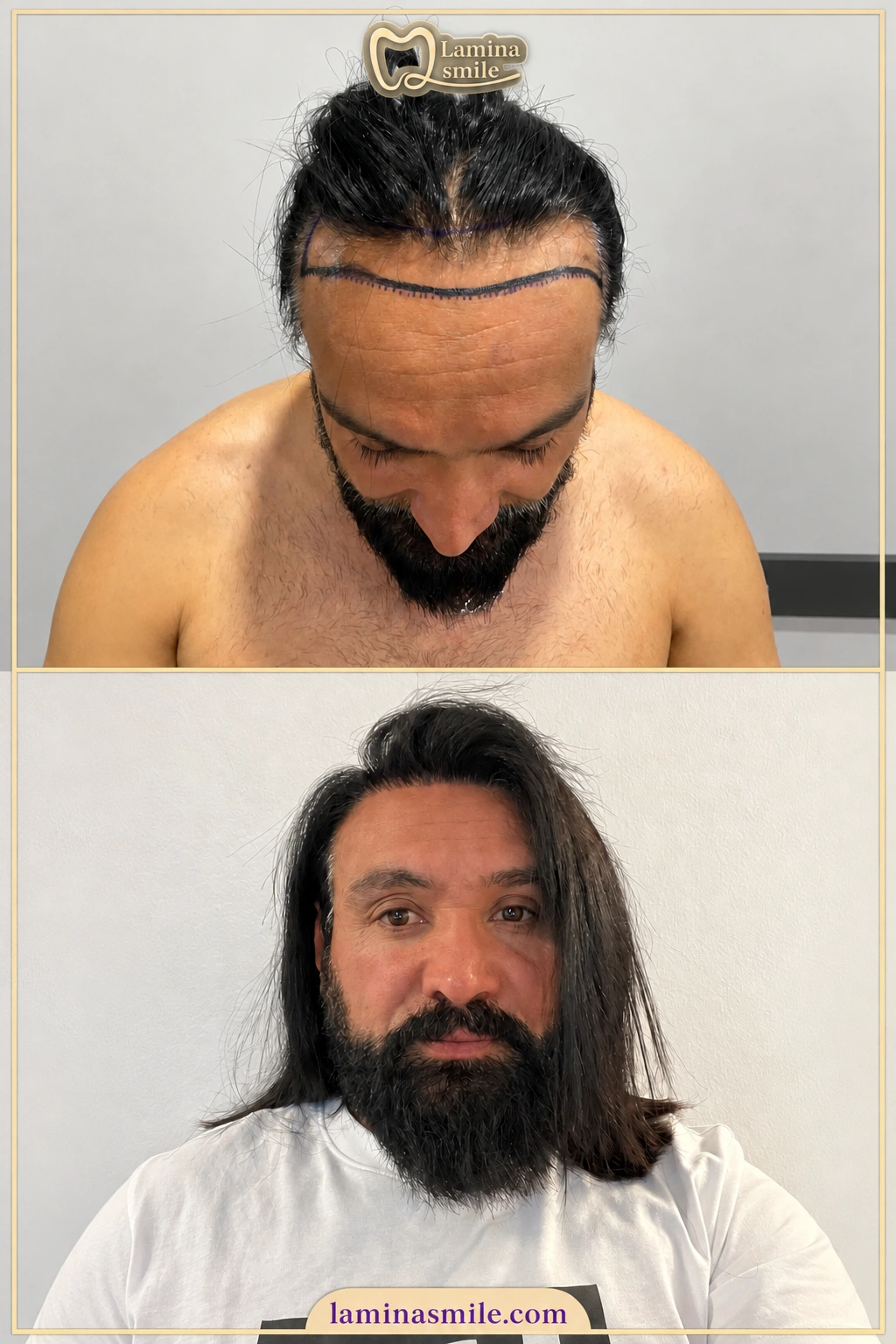 Clinic-supplied hair restoration case 3