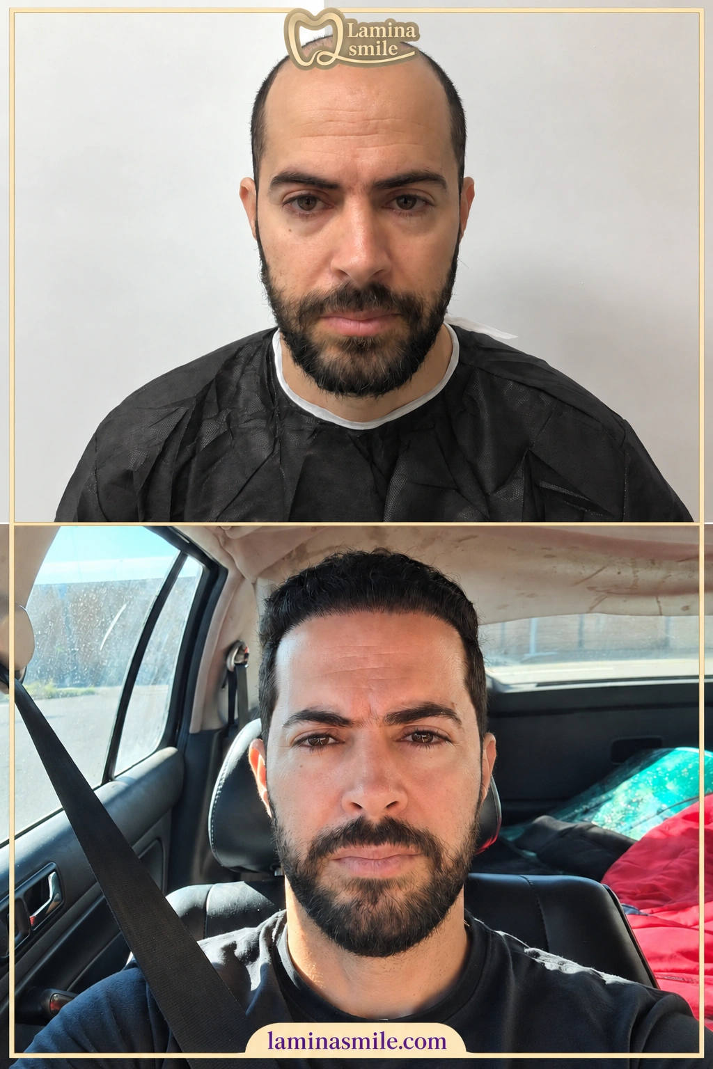 Clinic-supplied hair restoration case 2