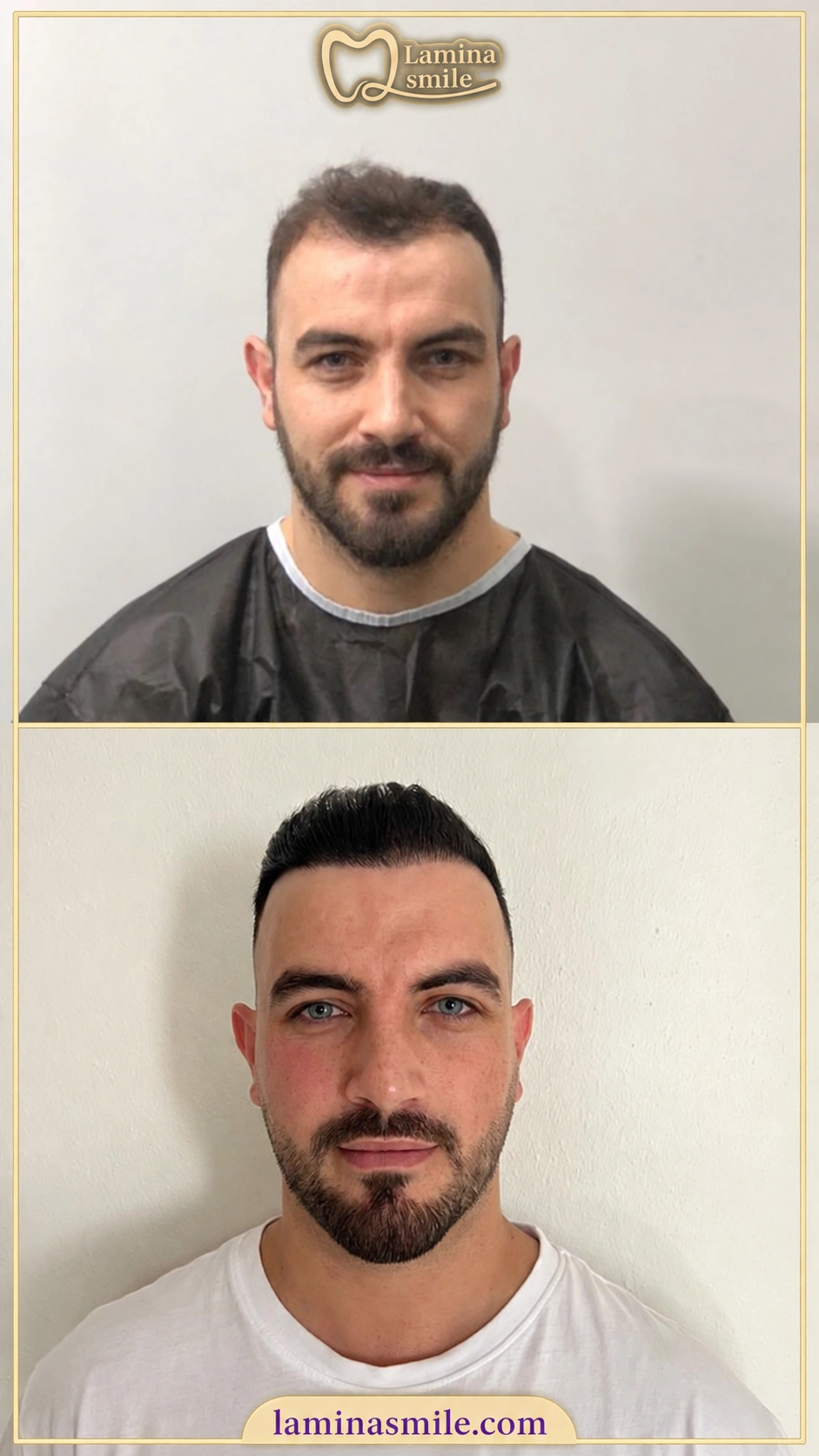 Clinic-supplied hair restoration case 1