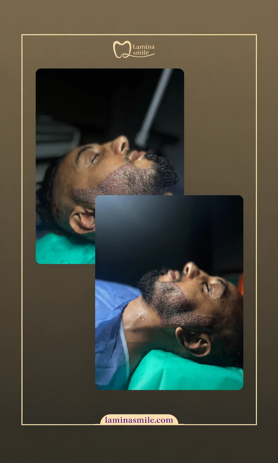Clinic-supplied beard restoration case 1