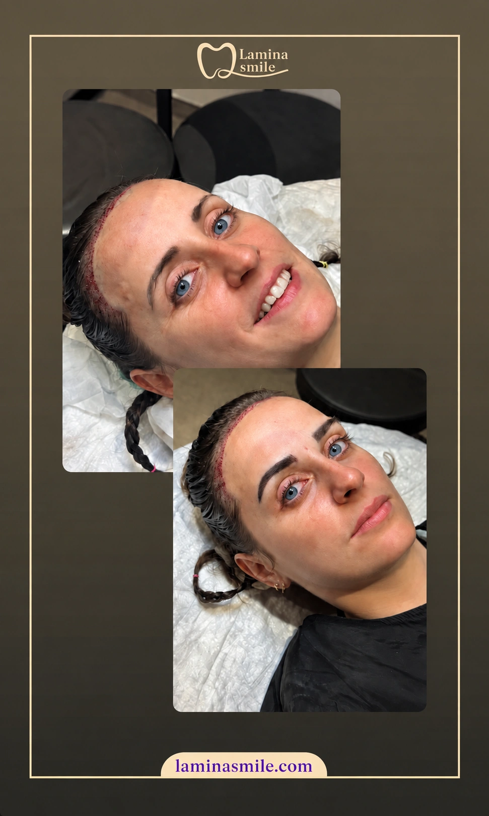 Clinic-supplied eyebrow restoration case 2
