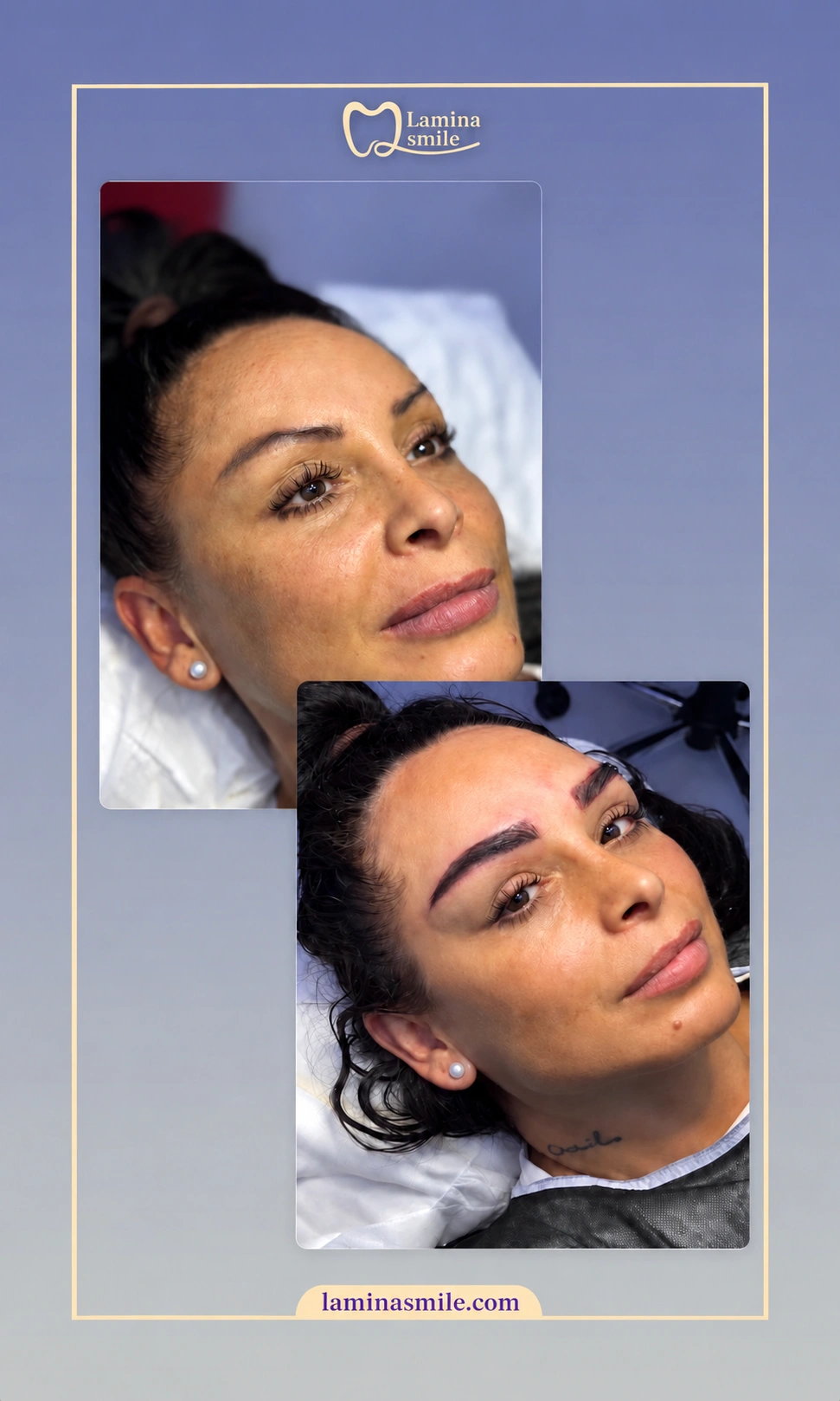Clinic-supplied eyebrow restoration case 1