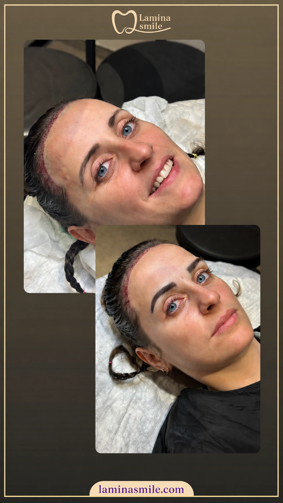 Clinic-supplied eyebrow restoration case 2