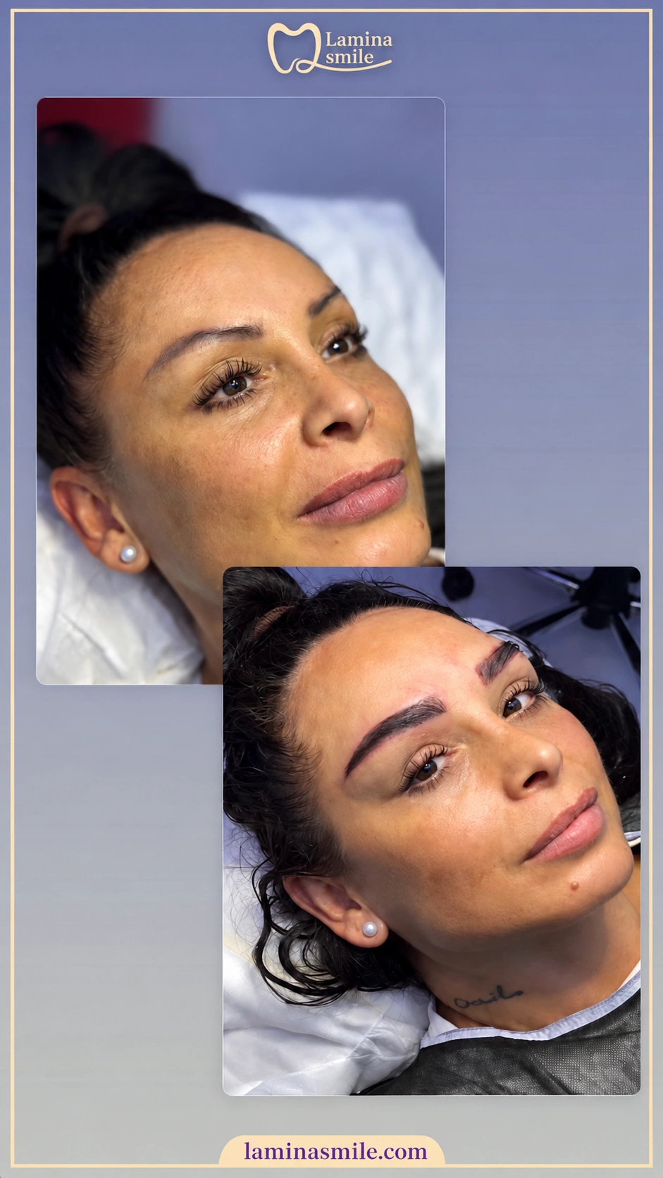 Clinic-supplied eyebrow restoration case 1