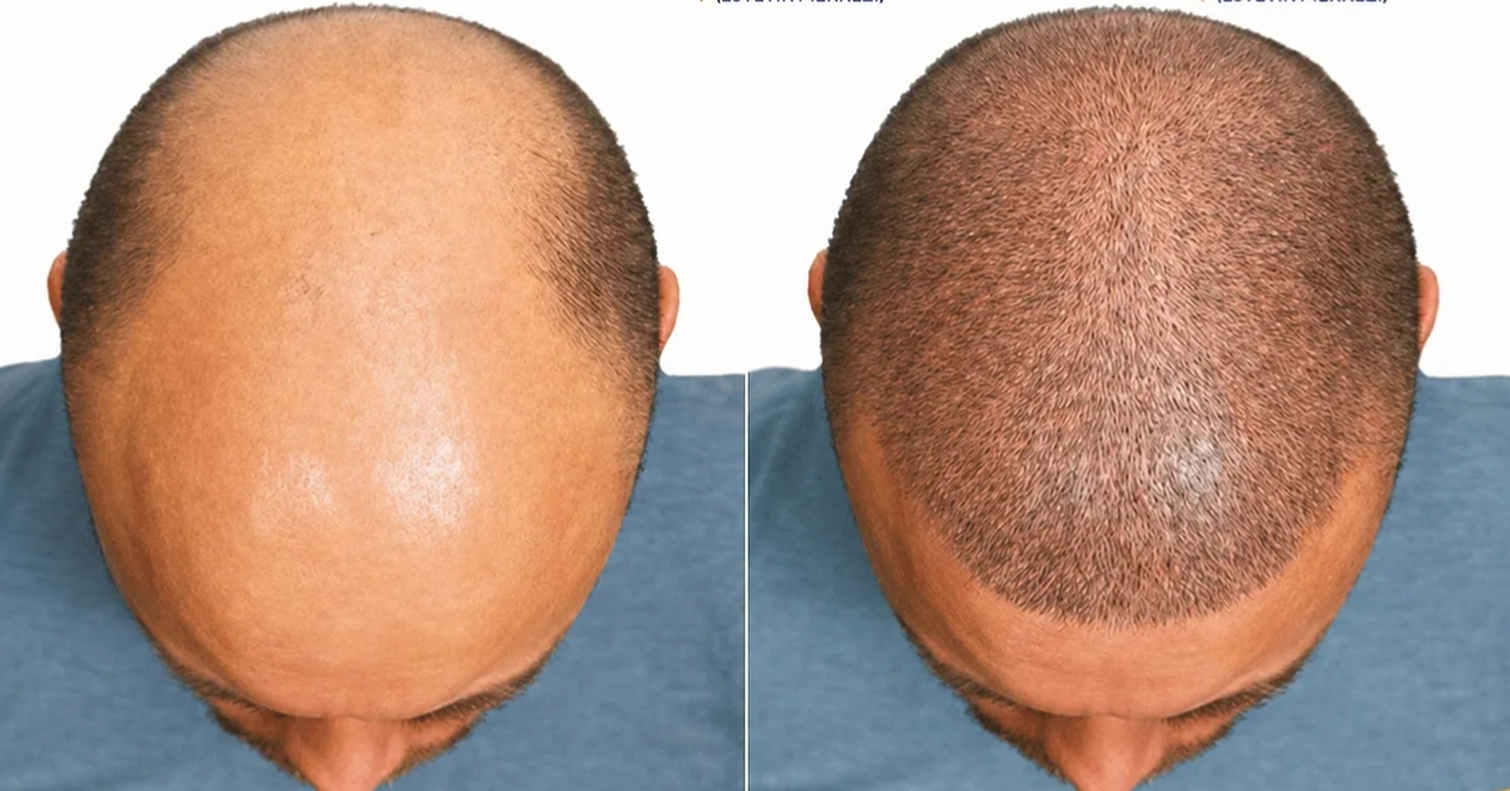 Clinic-supplied hair restoration before-and-after comparison