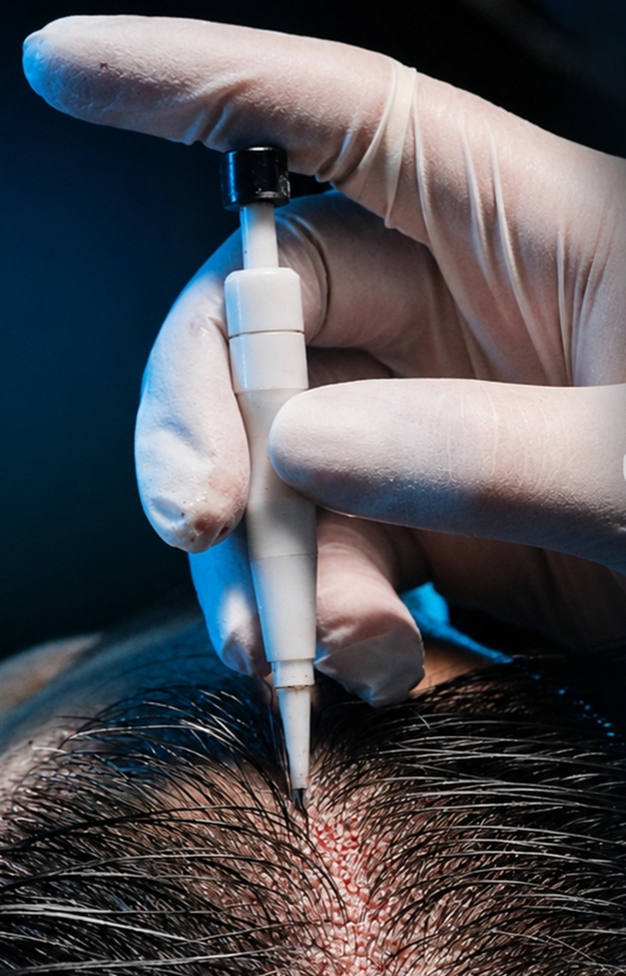 Close-up of a gloved clinician using a handheld device on the scalp
