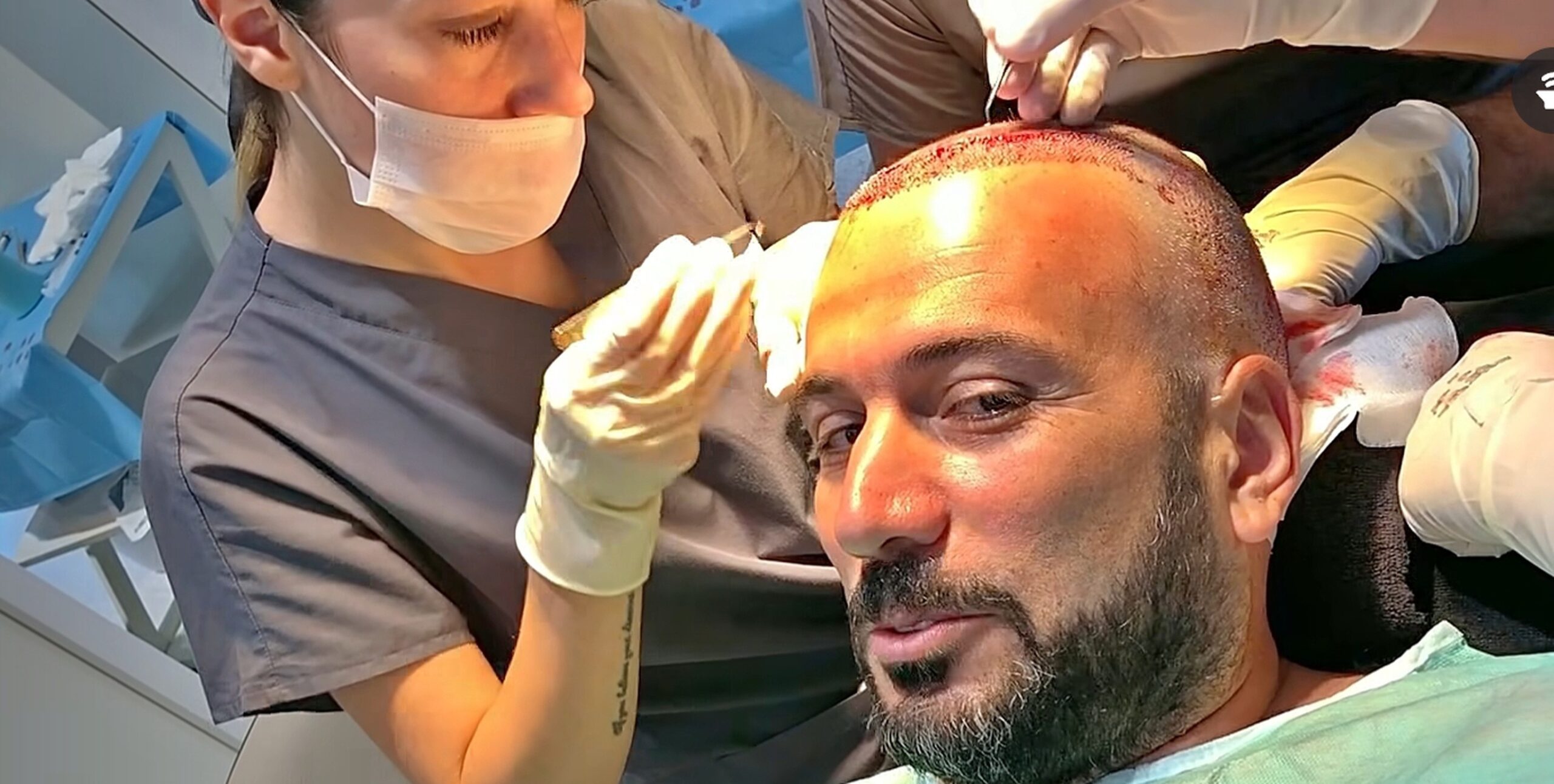Hair-restoration procedure in progress with clinicians working around a patient's frontal scalp