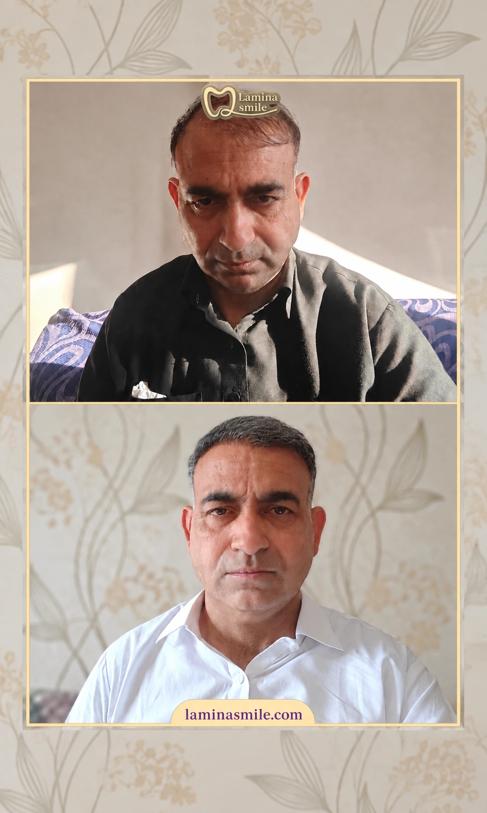 Clinic-supplied hair restoration case 7