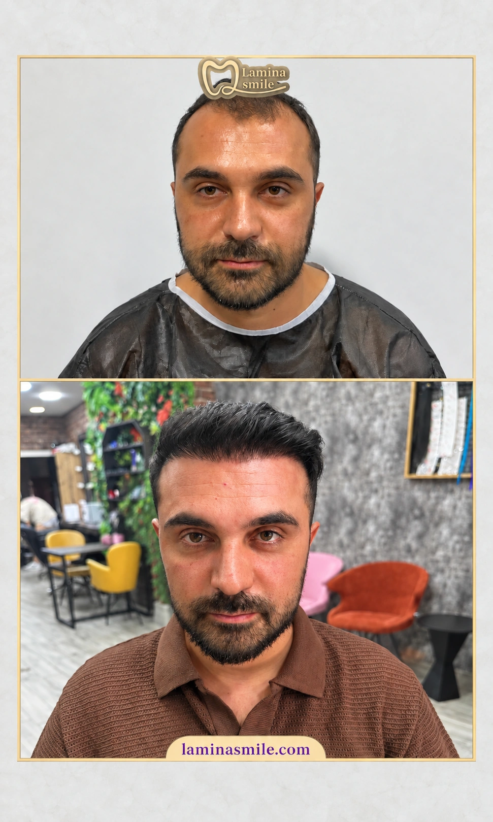 Clinic-supplied hair restoration case 6
