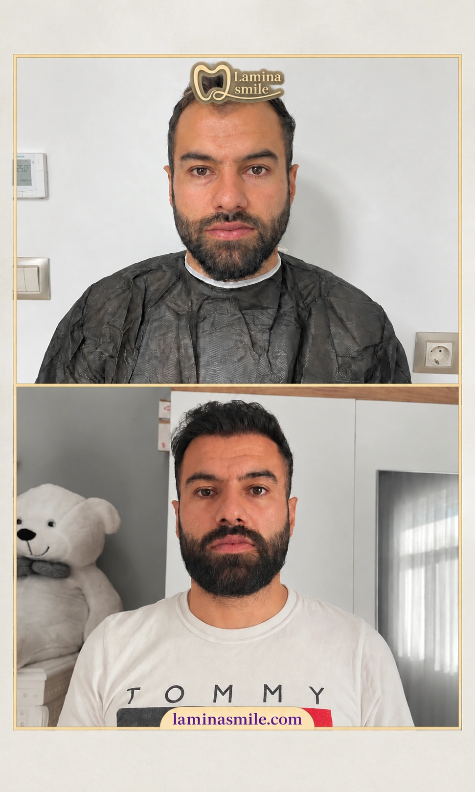 Clinic-supplied hair restoration case 5