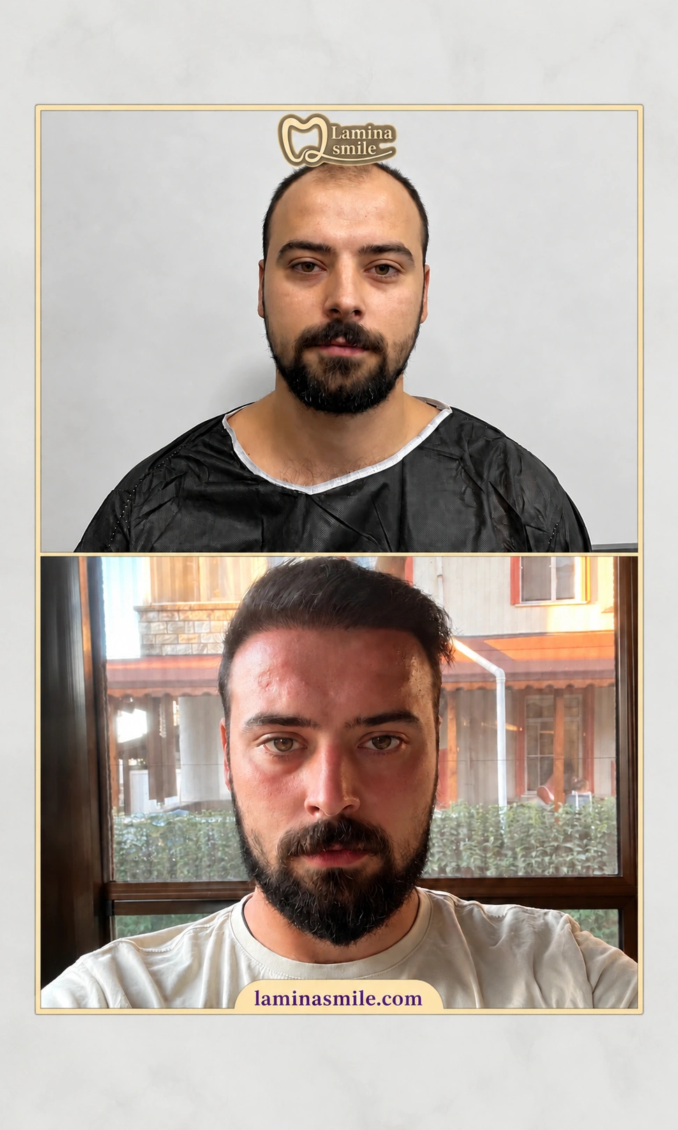 Clinic-supplied hair restoration case 4
