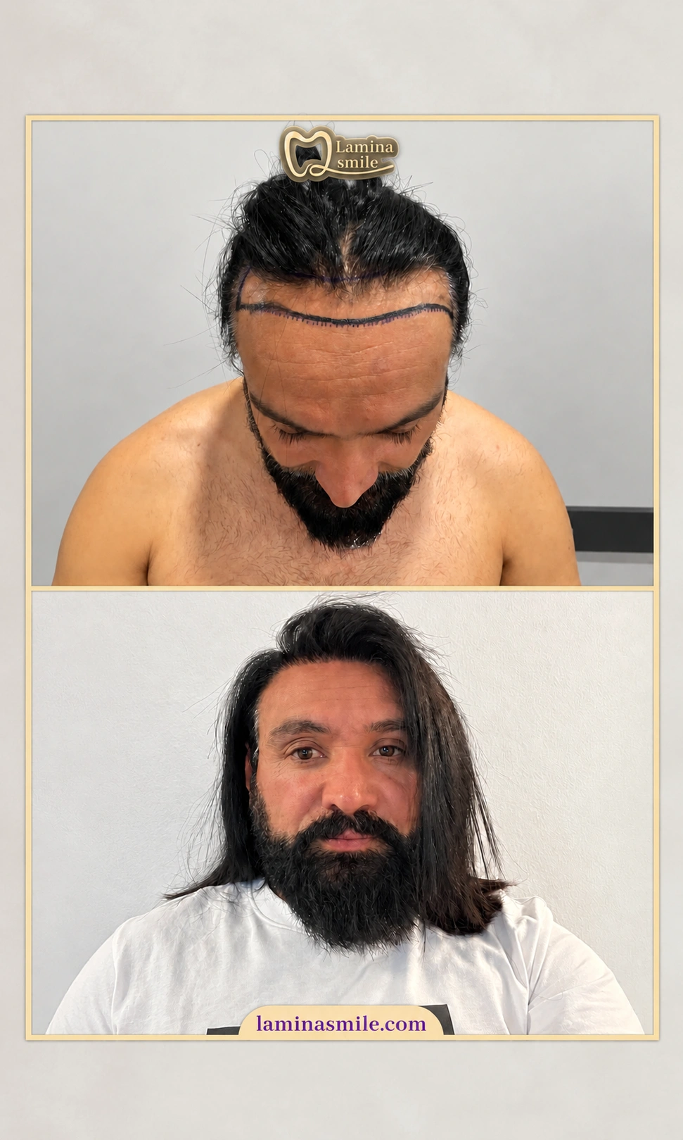 Clinic-supplied hair restoration case 3