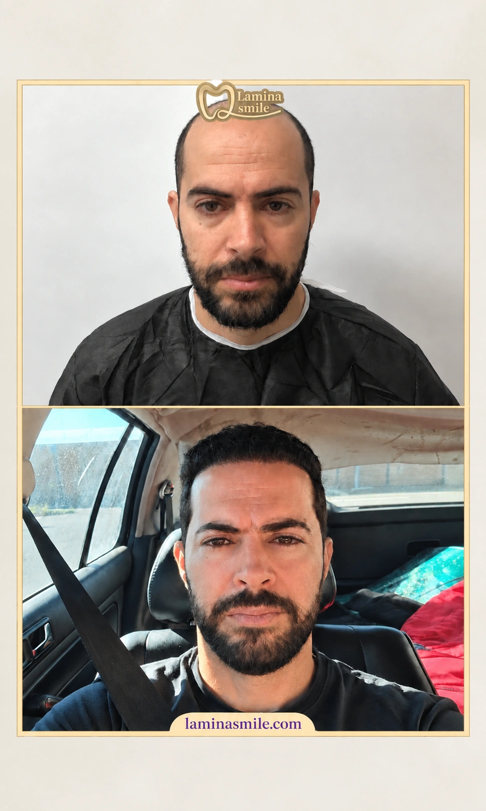 Clinic-supplied hair restoration case 2