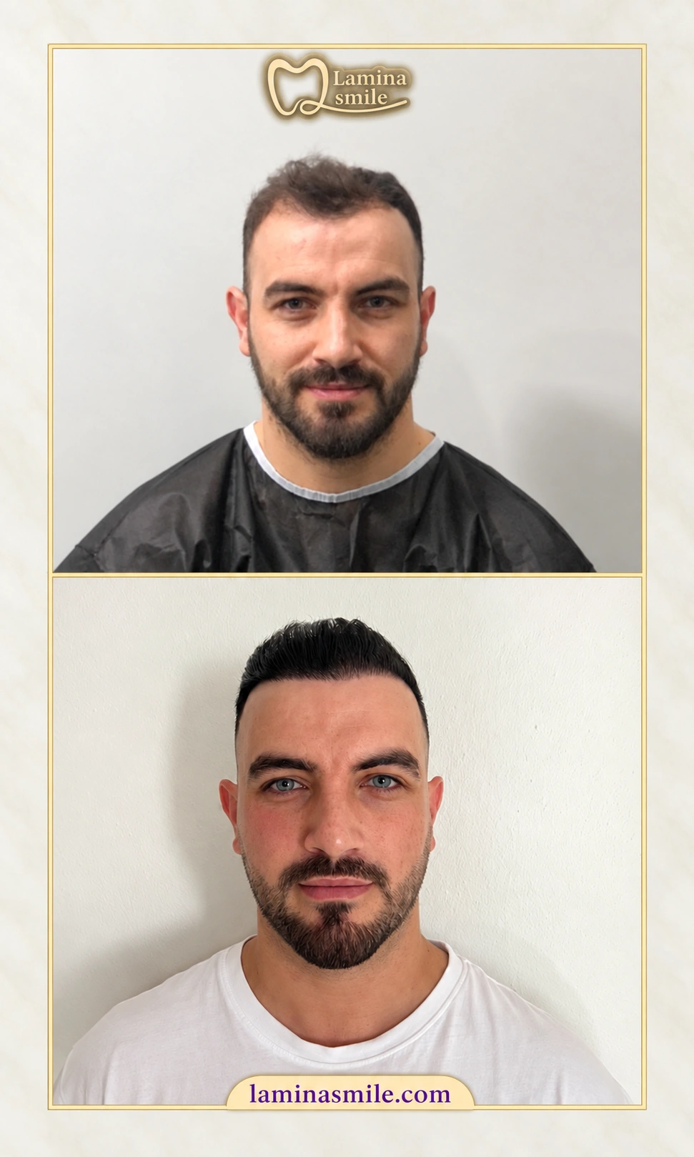 Clinic-supplied hair restoration case 1