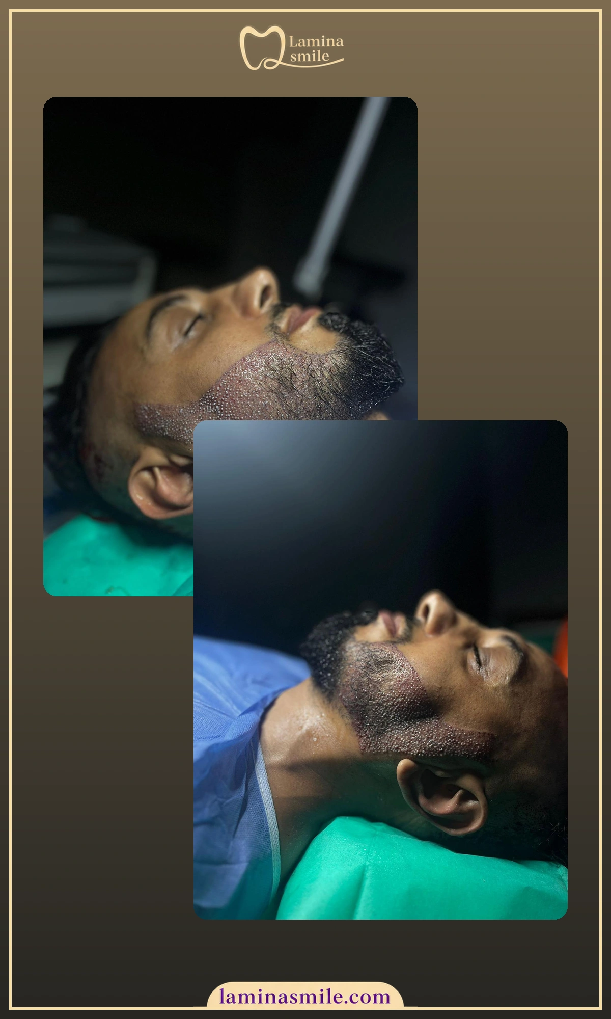 Clinic-supplied beard restoration case 1